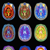 МРТ снимок человеческого мозга